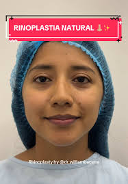 Rinoplastia Natural: Realza Tu Belleza