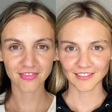 Browse sculptra aesthetic before & after photos shared by doctors on realself. Sculptra Tampa Bay Florida Perich Aesthetics