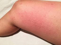 Dosierung und art der anwendung: Kalteallergie Kalteurtikaria Symptome Und Ursachen Zava Dred