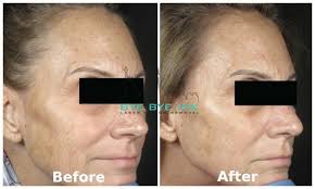 Piqo4 capacity laser to treat a variety of skin conditions, including tattoo removal, its customers med spa trio offers an attractive range of. Laser Skin Resurfacing Nyc Bye Bye Ink Laser Tattoo Removal