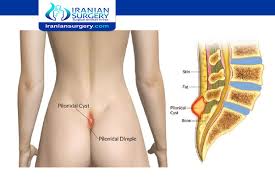 Pilonidal sinus is an abnormal pocket or a cleft between the buttocks just below the base of the spine that may develop due to a variety of reasons including hormonal or genetic ones. Why Do Pilonidal Cysts Smell So Bad Are Pilonidal Cysts Cancerous