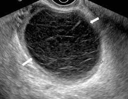 Image result for corpus luteum sonography)