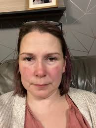 Itchy skin symptoms and lupus relation?