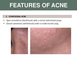 It's gentler than chemical exfoliating but will attract the oil/sebum and come right off. Acne Vulgaris
