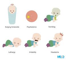 Image result for Hydrocephalus