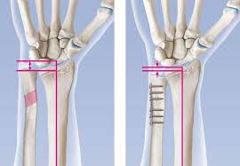 Ulna Impaktions Syndrom Ursachen Symptome Behandlung Ksw