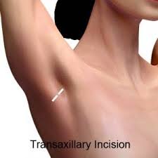 We did not find results for: 5 S S Of Breast Augmentation Scar Location Options