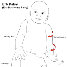 Waiter's tip position erb's palsy. Erb S Palsy Or Erb Duchenne Palsy Is A Medicine For All Facebook