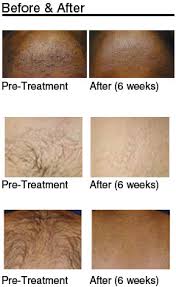 This is a natural process of laser hair removal and the hair is now in a shedding stage. Hair Laser Removal Things That You Need To Understand Arnoldlobes S Blog