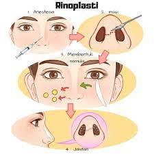 Mereka akan merasa lebih cantik lagi jika memiliki hidung yang mancung sempurna. Bagaimanakah Rinoplasti Dan Hidung Mancung Tanpa Bedah Dilakukan Di Malaysia Erufu Care
