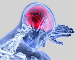 Emorragia cerebrale e ictus emorragico: Emorragia Cerebrale Che Cos E Sintomi Cause Prevenzione E Trattamento Top Doctors