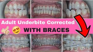 On average, invisalign treatment takes 12 to 18 months. Live Progress Report Underbite Corrected With Adult Braces And No Surgery With M E A W Technique Youtube