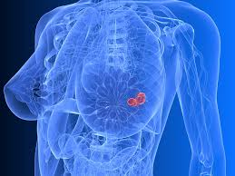 Despite recent advancements in medical technology, lung cancer is still one of the most dangerous diseases today. Why Breastfeeding Protects Against The Most Dangerous Type Of Breast Cancer International Milk Genomics Consortium