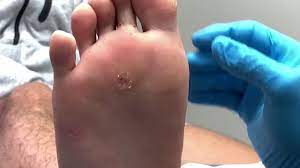 Side effects of cryotherapy include pain, blistering and discolored skin in the treated area. What Exactly Happens To The Wart Two Weeks After The Beetle Juice Is Applied Youtube