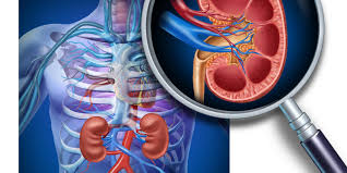 Pdf) Perirenal Fluid Collection In Renal Parenchymal Disease: The Kidney  Sweat Sign