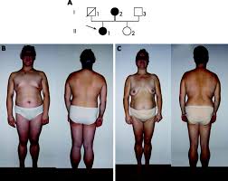 Image result for Lipodystrophy