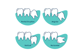 Do you know who did your extraction? Wisdom Teeth Lumino The Dentists