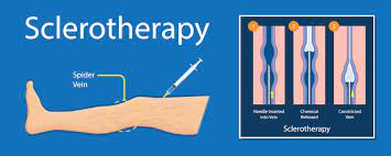 Varicose Vein Removal Long Island Sclerotherapy Long Island