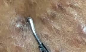 In this video, the hair in question looks like an unassuming red bump. Nauseating Video Shows Ingrown Hairs Being Squeezed From A Woman S Bikini Line Daily Mail Online