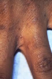 Image result for scabies on humans
