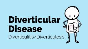 diverticular disease gastrointestinal society