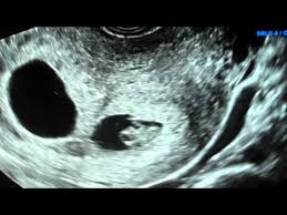 Twin ultrasound at 7 weeks | the sturgis twins plus one! 8 Weeks Pregnant With Twins Ultrasound Symptoms And More Twinstuff