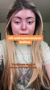 Eb Skin Condition Explained