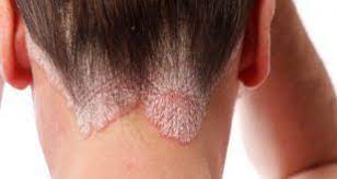 كلام جميل في الحب روائع العبارات مكتوبة عن الحب مصورة عالم ستات In 2020 Scalp Psoriasis Psoriasis Symptoms Psoriasis
