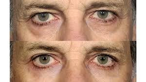 Share and like plas'me page and tag two people's name on this post to enter the draw. Eye Bag Surgery Costs Benefits Risks Recovery Time And More
