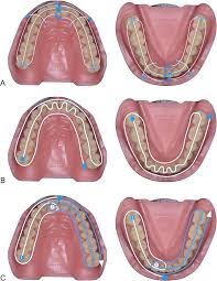 Precision of maxillo-mandibular registration with intraoral scanners in  vitro