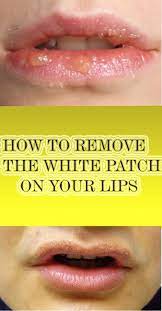 Maybe you would like to learn more about one of these? Get Rid Of Painful White Spots On Lips With The Following Remedies Now At Your Home Lip Allergy Sunburnt Lips Lips