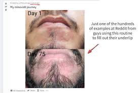 Before developing into a typical cyst, an infected ingrown hair normally begins as a small or big pimple. Beard Not Growing Under Lip Here S How To Fill The Gaps Beard Lips Facial Hair