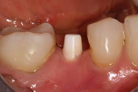 Free dental implants for veterans. When It Comes To Dental Implants Metal Free Is Your Best Bet Here S Why Dr Judson Wall
