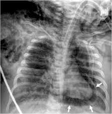 The Imaging Appearances Of Various Pericardial Disorders Insights Into Imaging Full Text