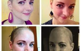 Applying minoxidil — a drug approved for hair loss — to your scalp before and during chemotherapy isn't likely to prevent your hair loss, although some research shows it may speed up your hair regrowth. Hair Regrowth After Cancer And Why I Ditched The Wigs Breast Cancer Now