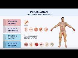 Penyakit ini dapat menyebabkan kerusakan permanen pada saraf, jaringan tubuh, dan otak jika tidak ditangani. Video Penanganan Penyakit Sifilis Kompilasi Youtube