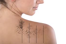 Alec is a trail blazer in tattoo removal. Tattoo Removal Soma Vein Clinic