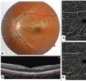 Multimodal imaging for paracentral acute maculopathy; the ...