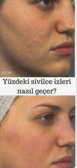 Yuzdeki Sivilce Izleri Nasil Gecer Etkili Yontemler Sivilce Izi Yuzler Iz