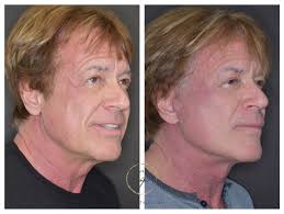 Happy Wednesday! ✨ Here we have a male face & necklift patient of mine who  is looking amazing! He was ready for a refresh but still wanted to look  like himself (which