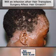 Will An Infection After Hair Transplant Surgery Affect Hair Growth Hair Transplant Surgery Hair Transplant Hair Loss Medication