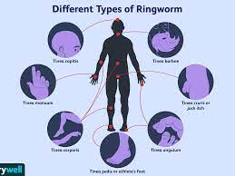 These products kill the main dermatophytes that cause ringworm. Ringworm Overview And More