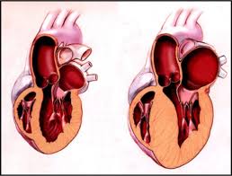 Hypertrophic cardiomyopathy- Cardiomyopathy | Homeopathic | Best Homeopathic Doctor in Pakistan | Dr Qaisar Ahmed MD, DHMS