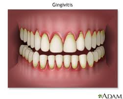 Herpetic gingivostomatitis is often the initial presentation during the first (primary) herpes simplex infection. Gingivostomatitis Information Mount Sinai New York