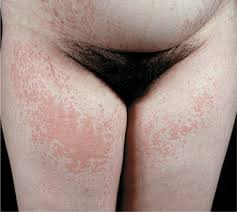 Image result for pruritic urticarial papules and plaques of pregnancy