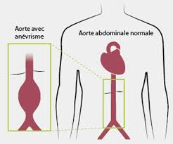 Un anévrisme de l'aorte abdominale peut être fatal s'il y a rupture mais un traitement efficace peut empêcher cette rupture de se produire. La Rupture D Anevrisme De L Aorte Abdominale