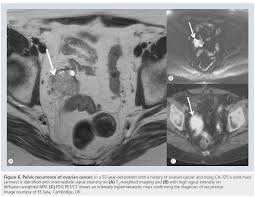 Learn how msk can help if you develop symptoms. Mri In Ovarian Cancer