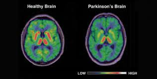 Parkinson's disease (pd) is a degenerative neurological disease that affects the movement. What Is Parkinson S Disease In Sarasota