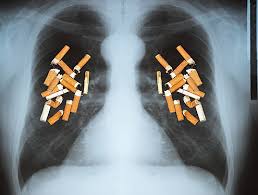 Image result for lung cancer xray