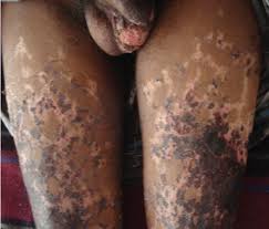 Often associated with severe protein c deficiency.9 purpura fulminans is a haematological emergency so early recognition and initiation of immediate treatment to prevent the complications is mandatory. Indian Journal Of Dermatology Venereology And Leprology Spectrum Of Purpura Fulminans Report Of Three Classical Prototypes And Review Of Management Strategies